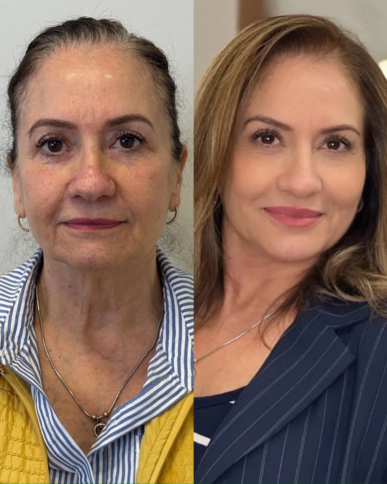 Resultado real de harmonização facial em Curitiba, Dra. Rebeca Aghion