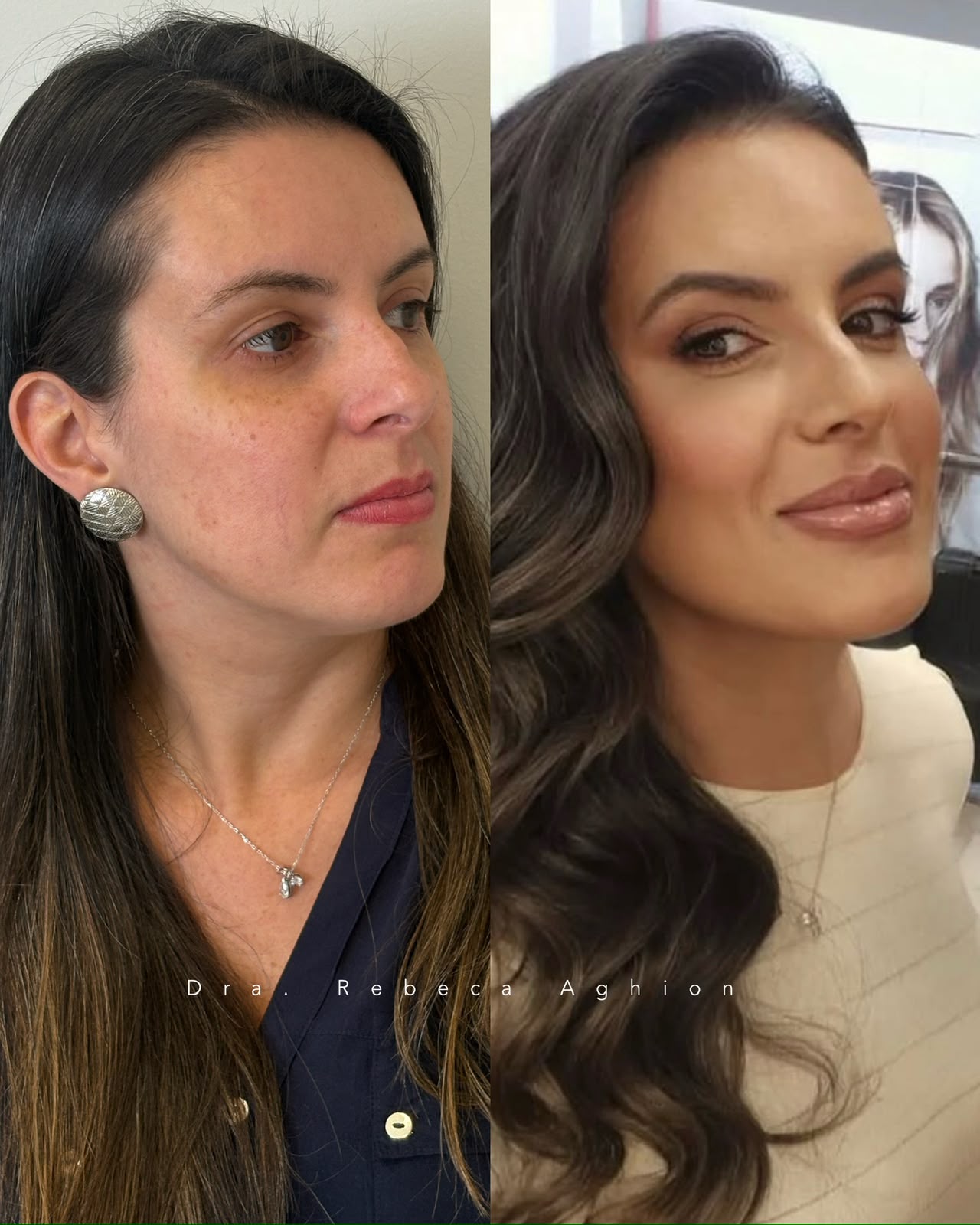 Resultado real de harmonização facial em Curitiba, Dra. Rebeca Aghion