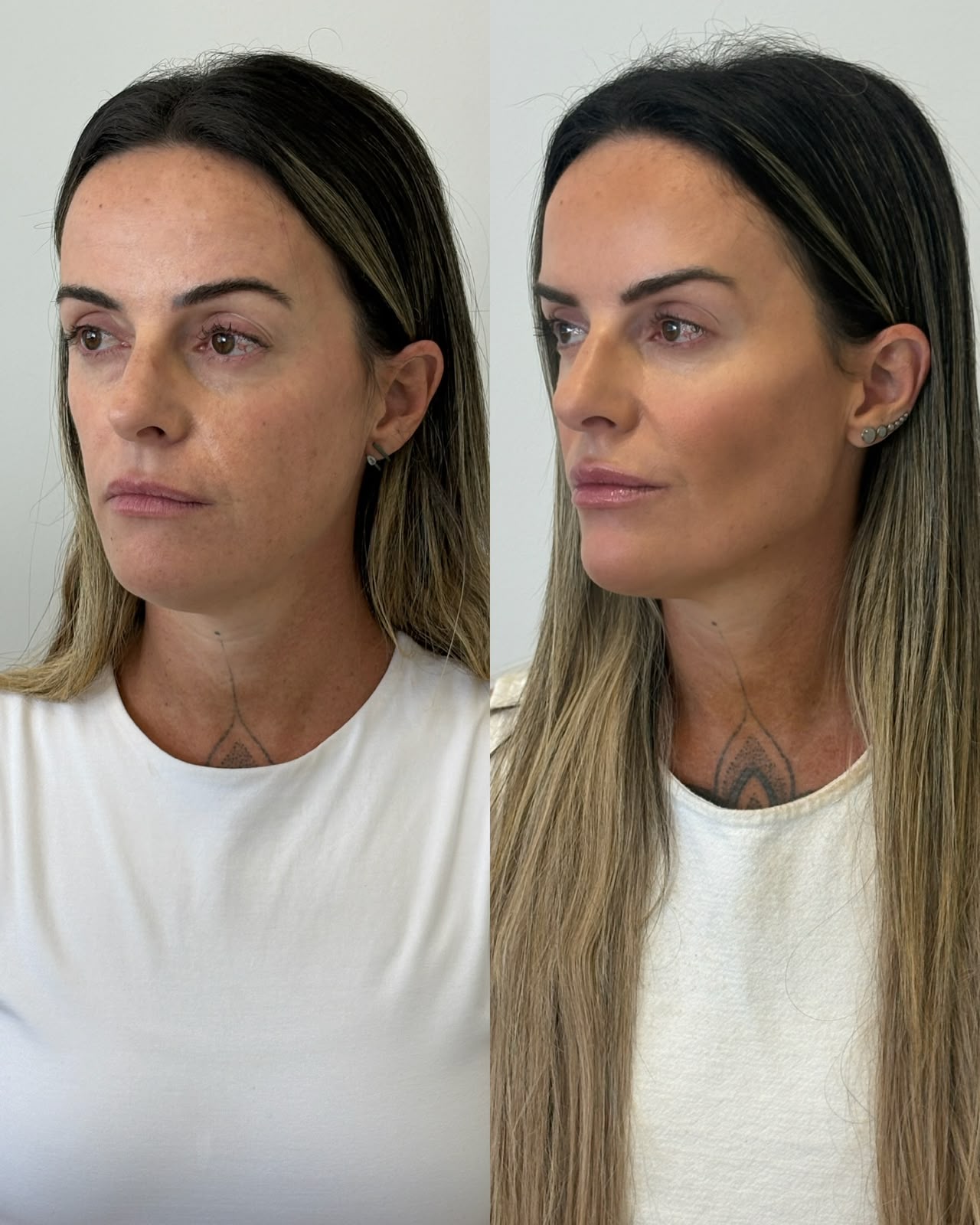 Resultado real de harmonização facial em Curitiba, Dra. Rebeca Aghion