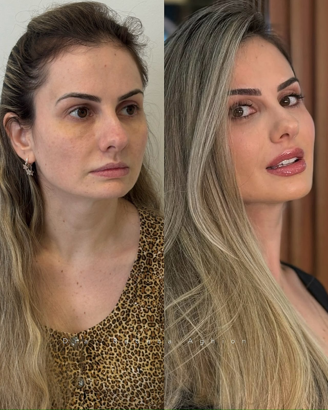 Resultado real de harmonização facial em Curitiba, Dra. Rebeca Aghion