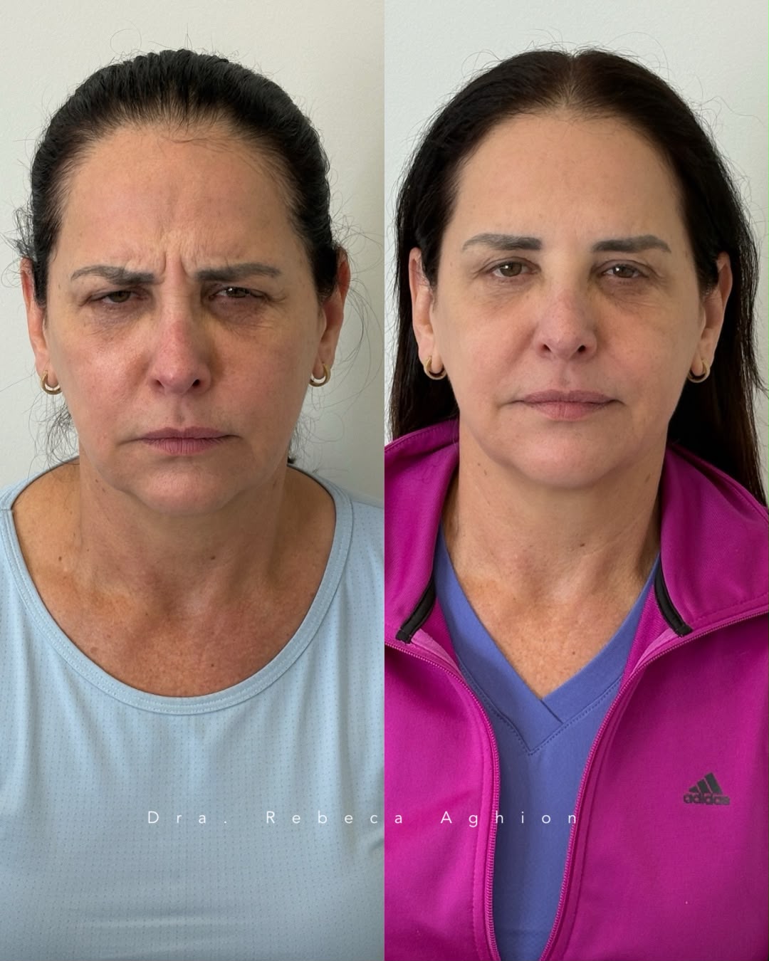 antes e depois de botox facial em Curitiba, Dra. Rebeca Aghion