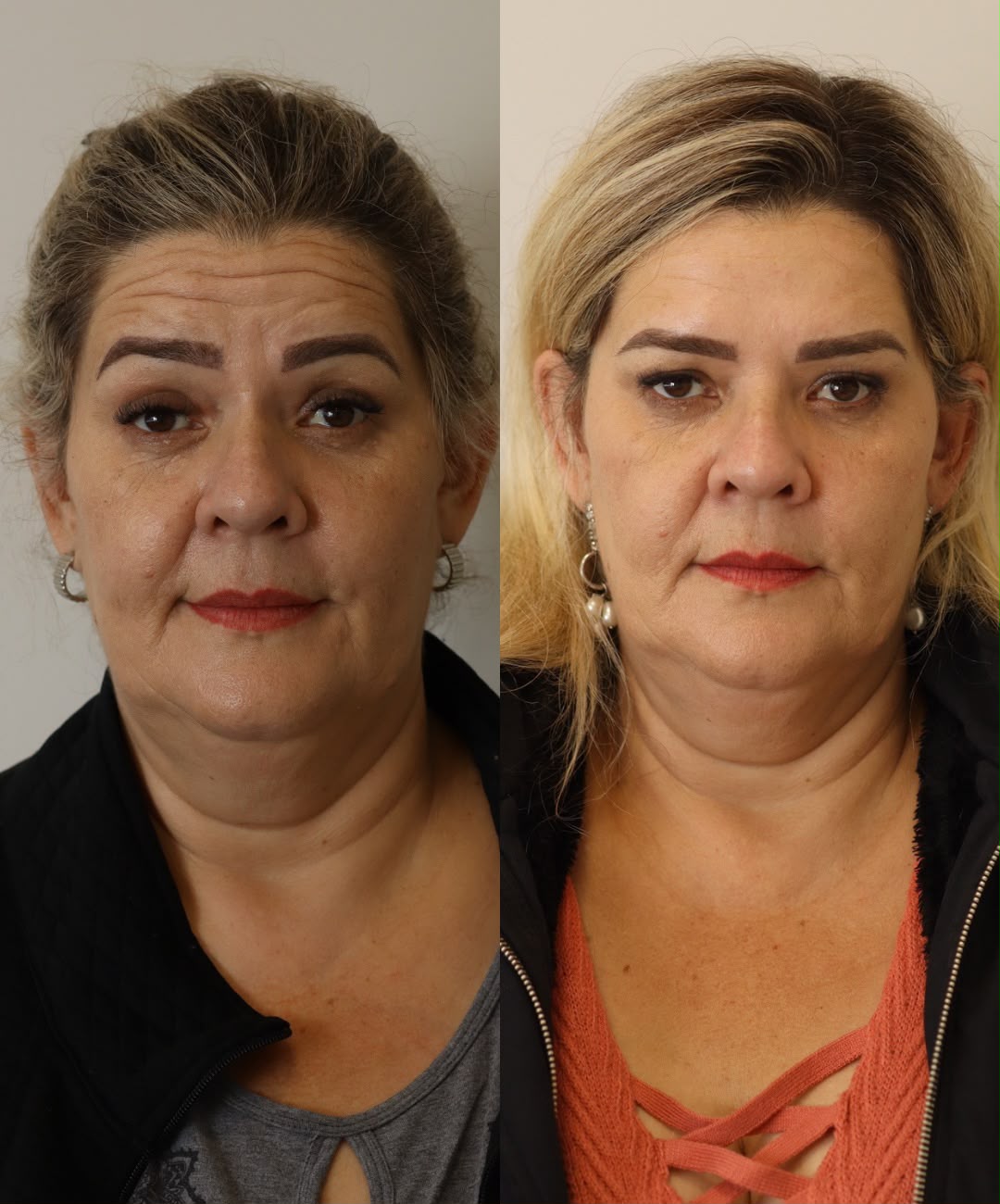 antes e depois de botox facial em Curitiba, Dra. Rebeca Aghion