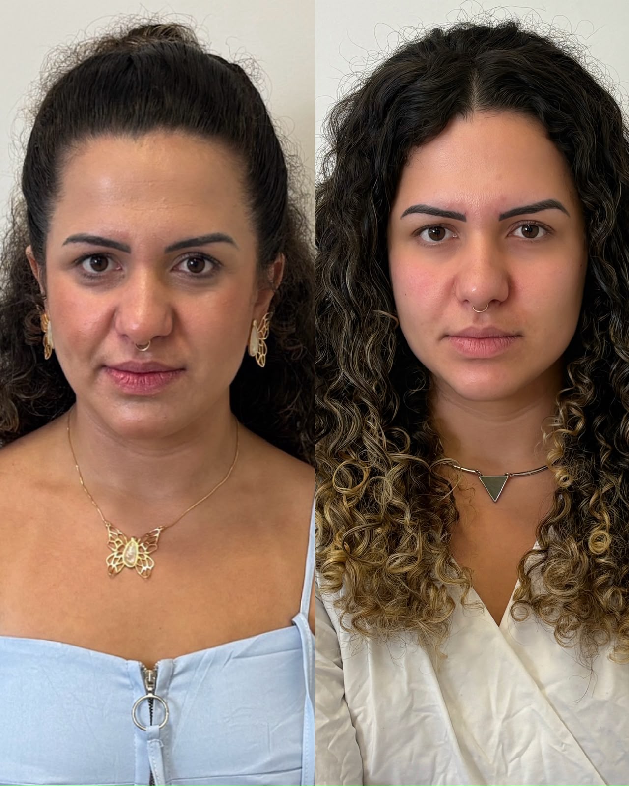antes e depois de botox facial em Curitiba, Dra. Rebeca Aghion