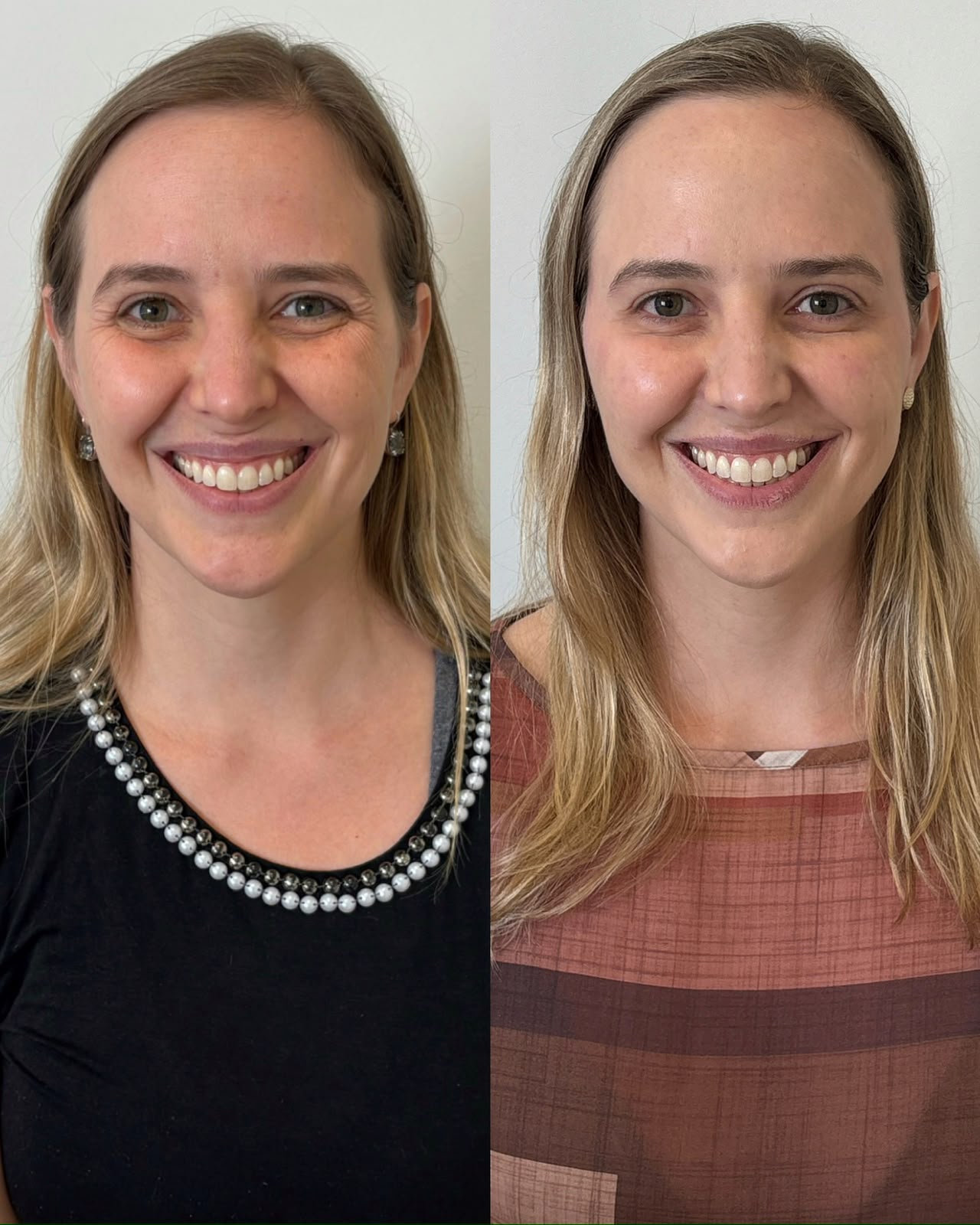 antes e depois de botox facial em Curitiba, Dra. Rebeca Aghion