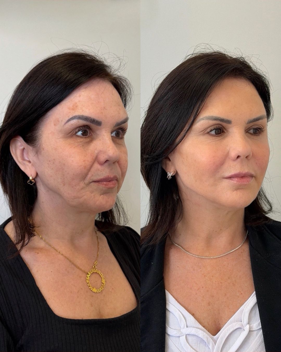 Resultado de Harmonização Facial Full Face em Curitiba, Dra. Rebeca Aghion