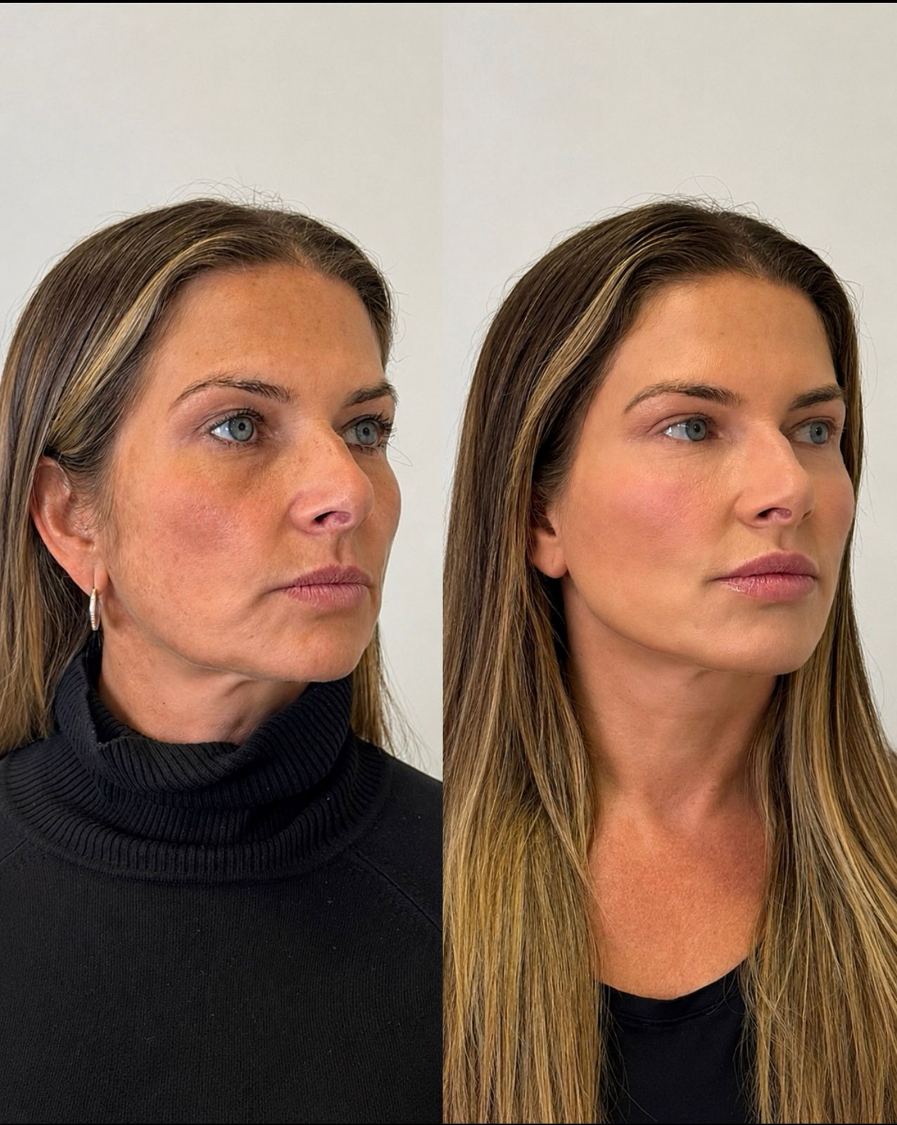 Resultado de Harmonização Facial Full Face em Curitiba, Dra. Rebeca Aghion