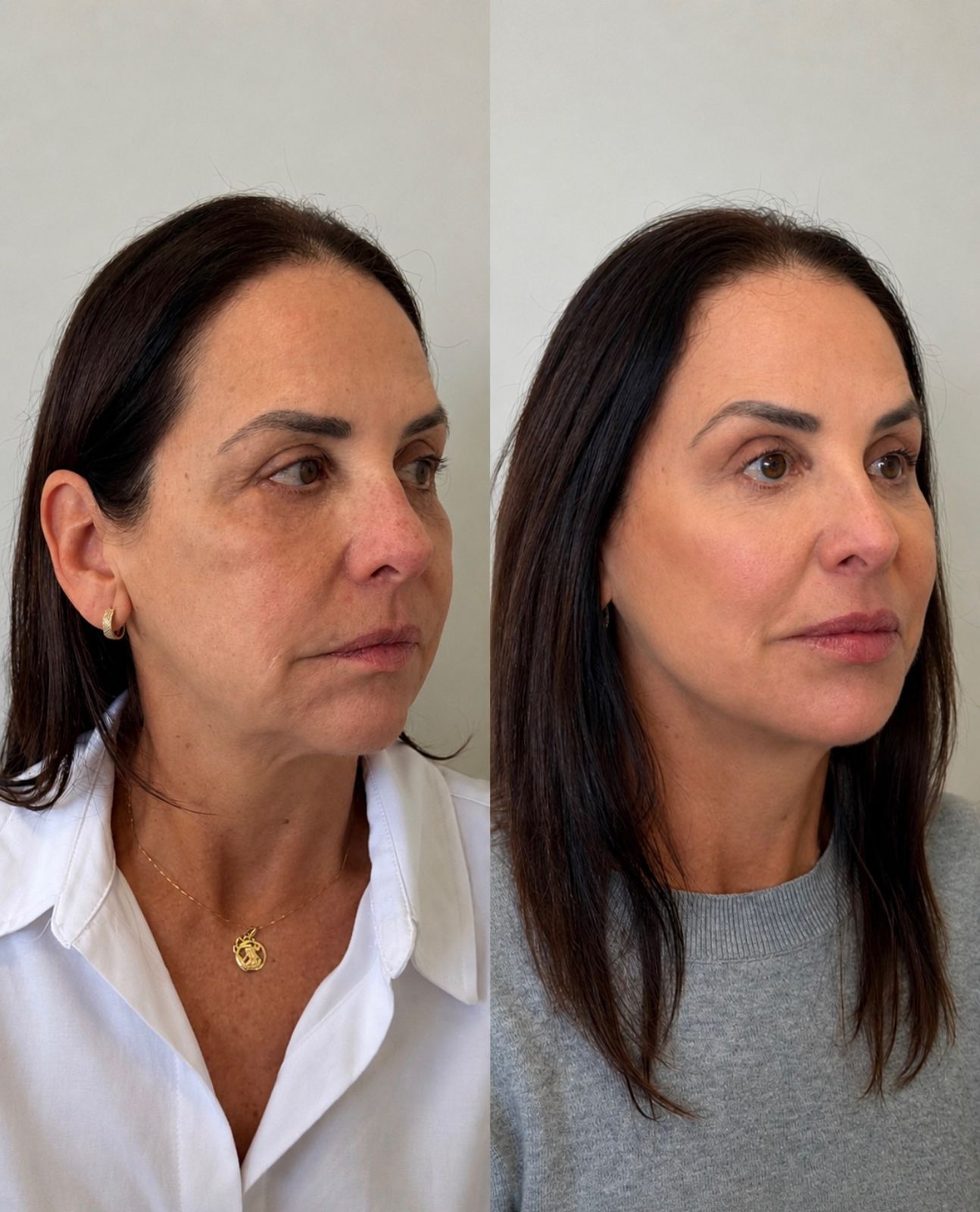 Resultado de Harmonização Facial Full Face em Curitiba, Dra. Rebeca Aghion