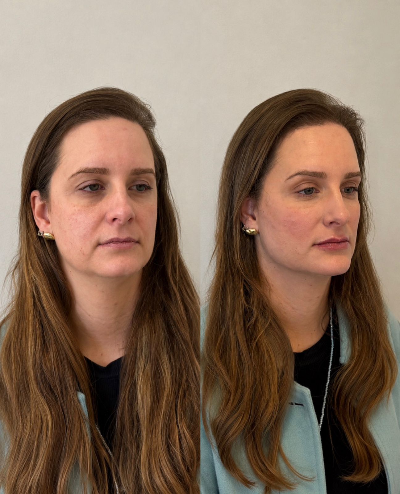 Resultado de Harmonização Facial Full Face em Curitiba, Dra. Rebeca Aghion