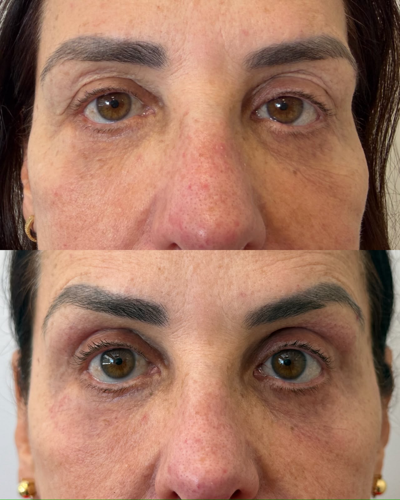 resultado blefaroplastia não cirúrgica plasma iq curitiba dra rebeca aghion