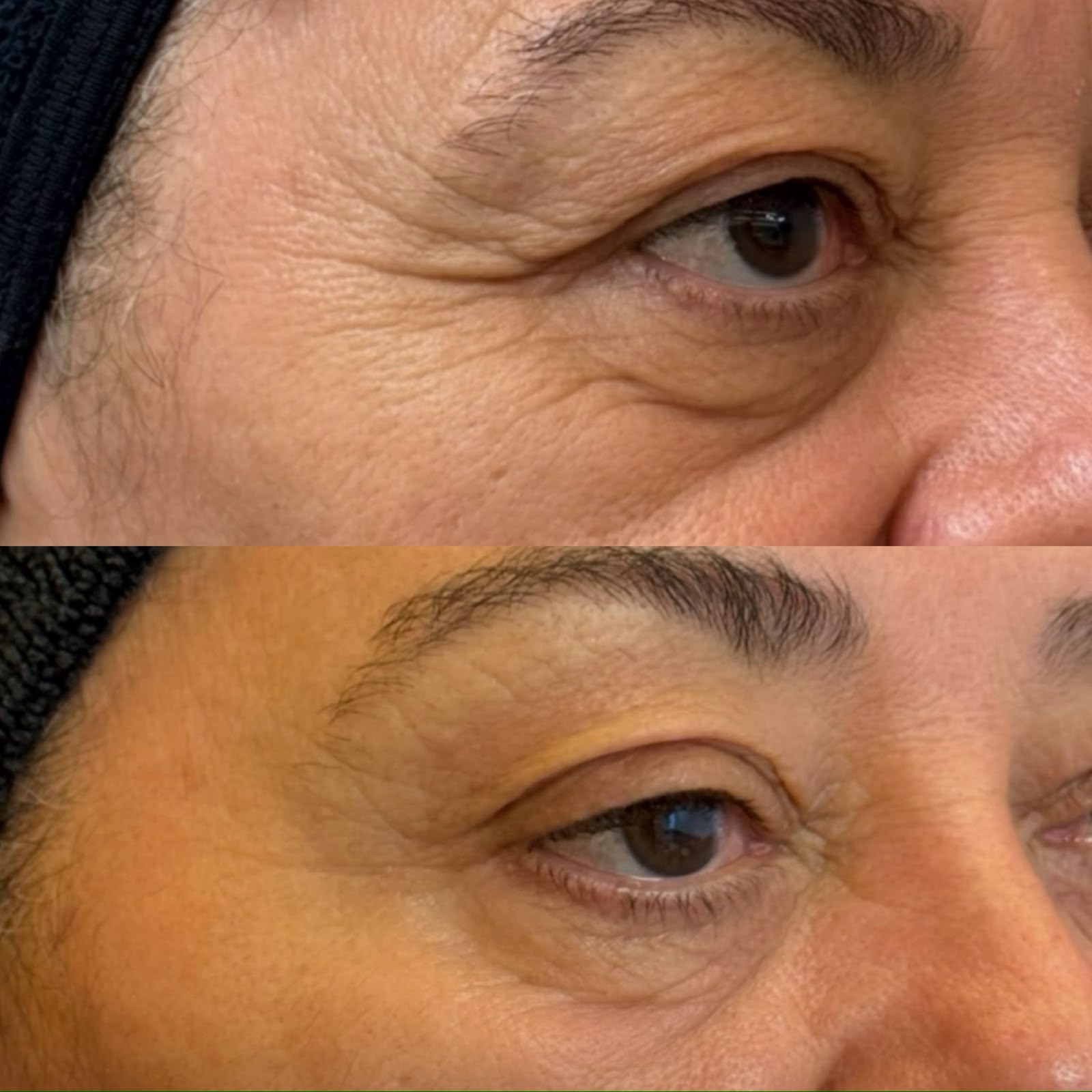 resultado blefaroplastia não cirúrgica plasma iq curitiba dra rebeca aghion
