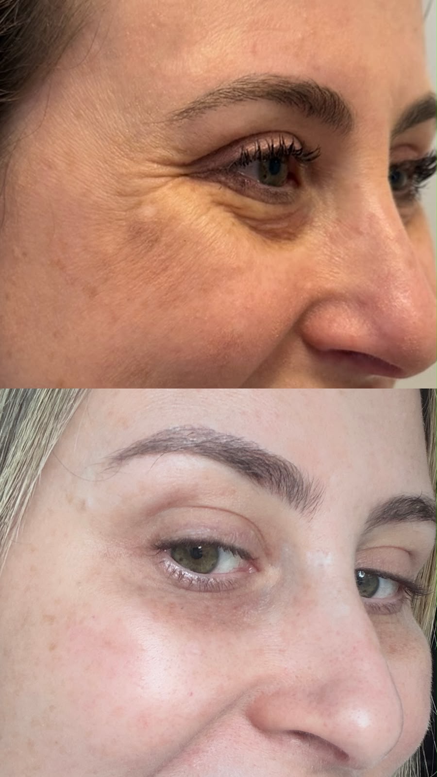 resultado blefaroplastia não cirúrgica plasma iq curitiba dra rebeca aghion