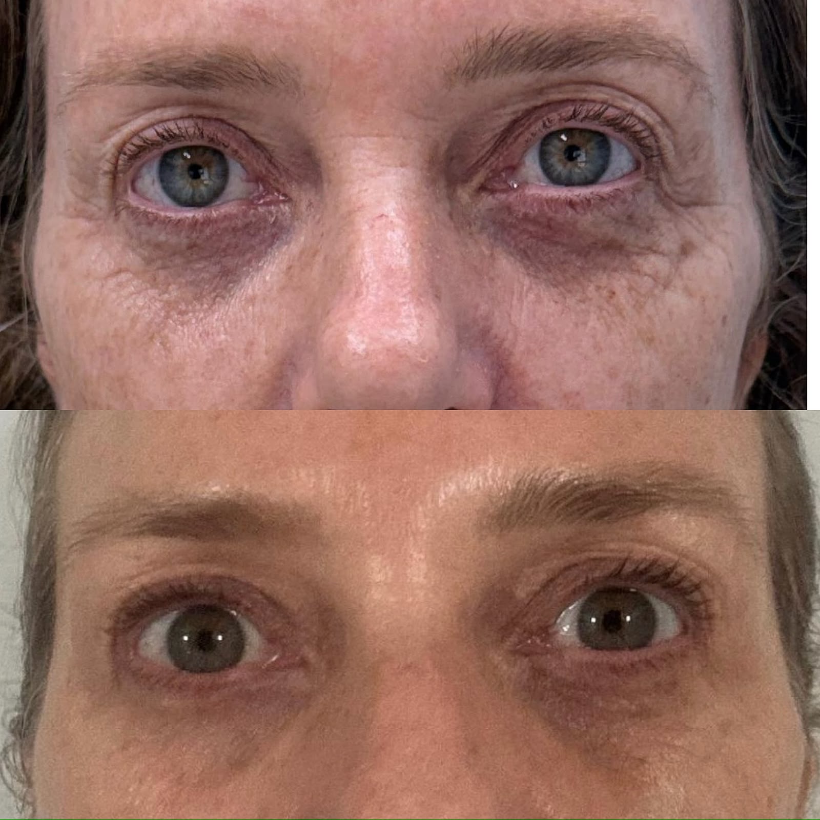 resultado blefaroplastia não cirúrgica plasma iq curitiba dra rebeca aghion